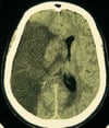 Middle Cerebral Artery Infarct
