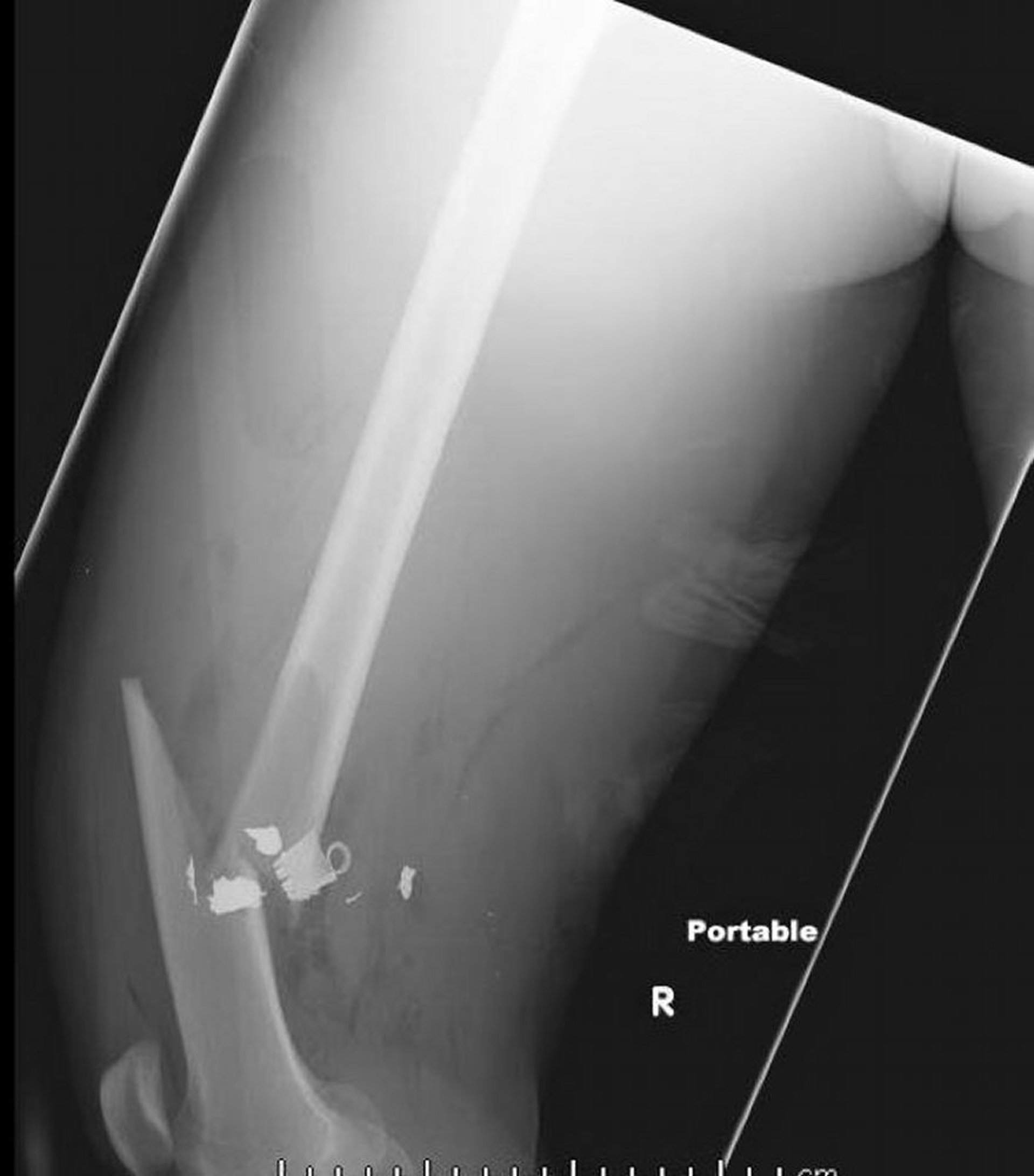 Fracture médiodiaphysaire du fémur (2)