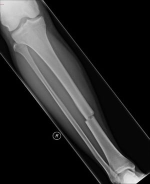Fractura transversal de la diáfisis de la tibia