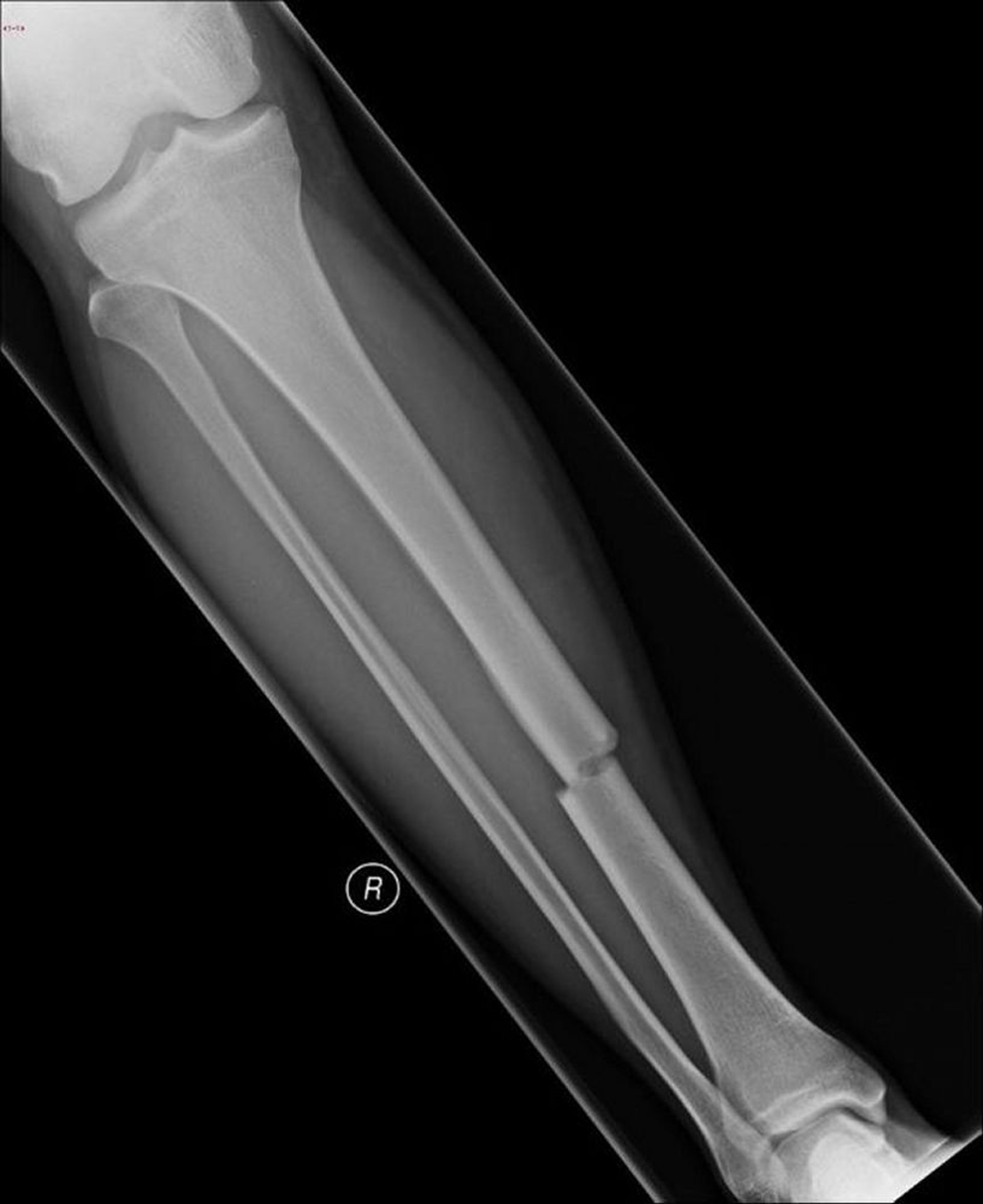 Fratura transversa da diáfise tibial