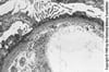 Minimal-Change-Glomerulonephritis