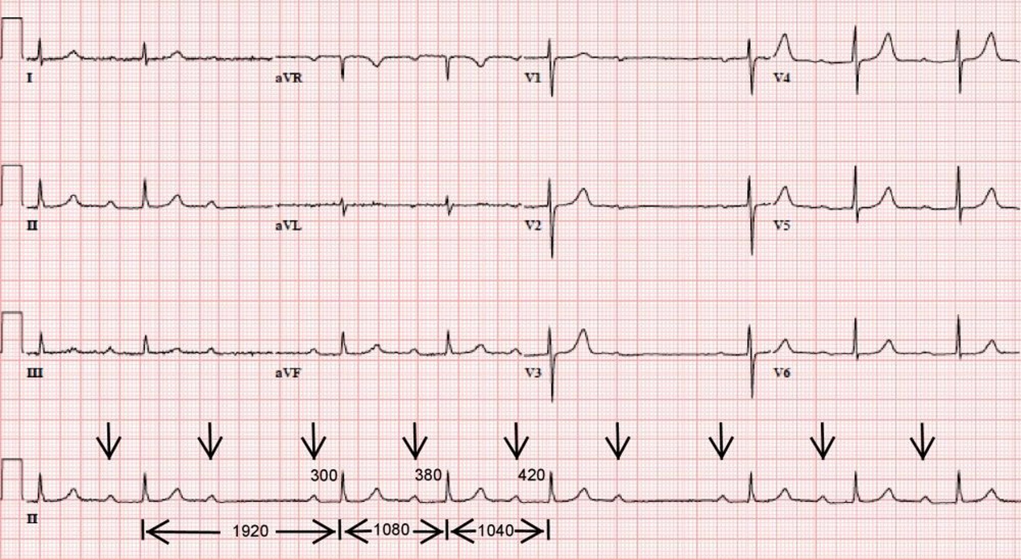 Classic 4:3 Mobitz Type I Second-Degree Atrioventricular Block