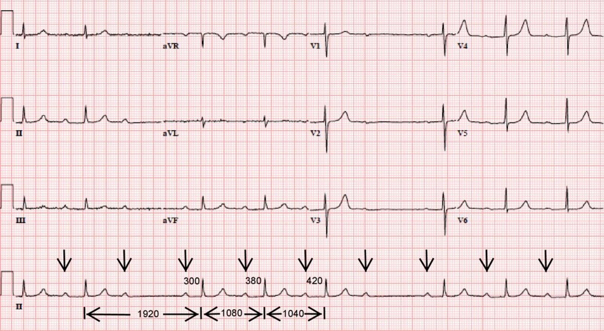 Bloqueo auriculoventricular 4:3 de segundo grado tipo Mobitz I clásico