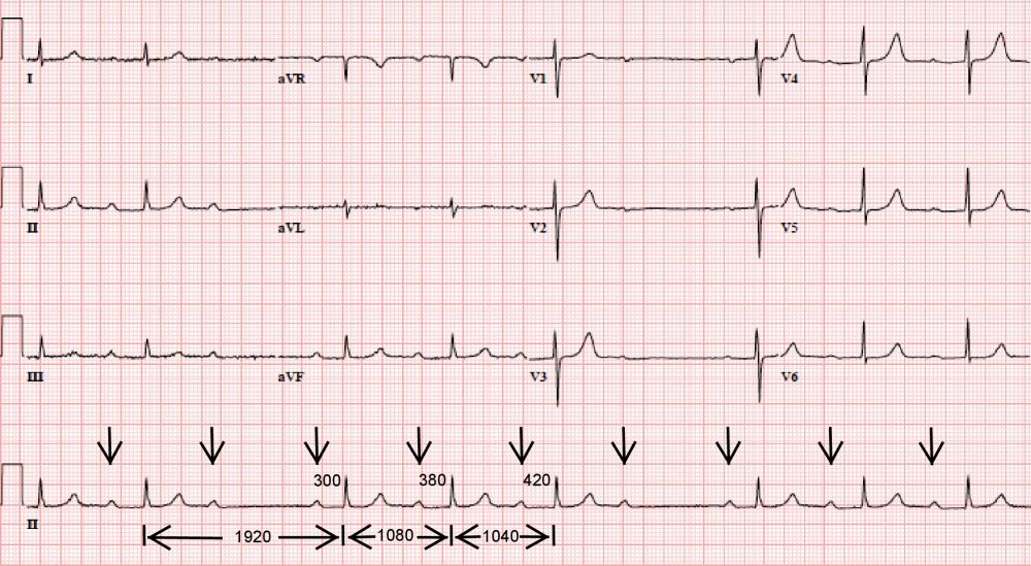 Bloqueo auriculoventricular 4:3 de segundo grado tipo Mobitz I clásico