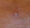 Mpox (2)