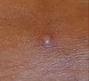 Mpox (2)