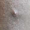 Mpox (3)