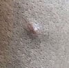 Mpox (3)