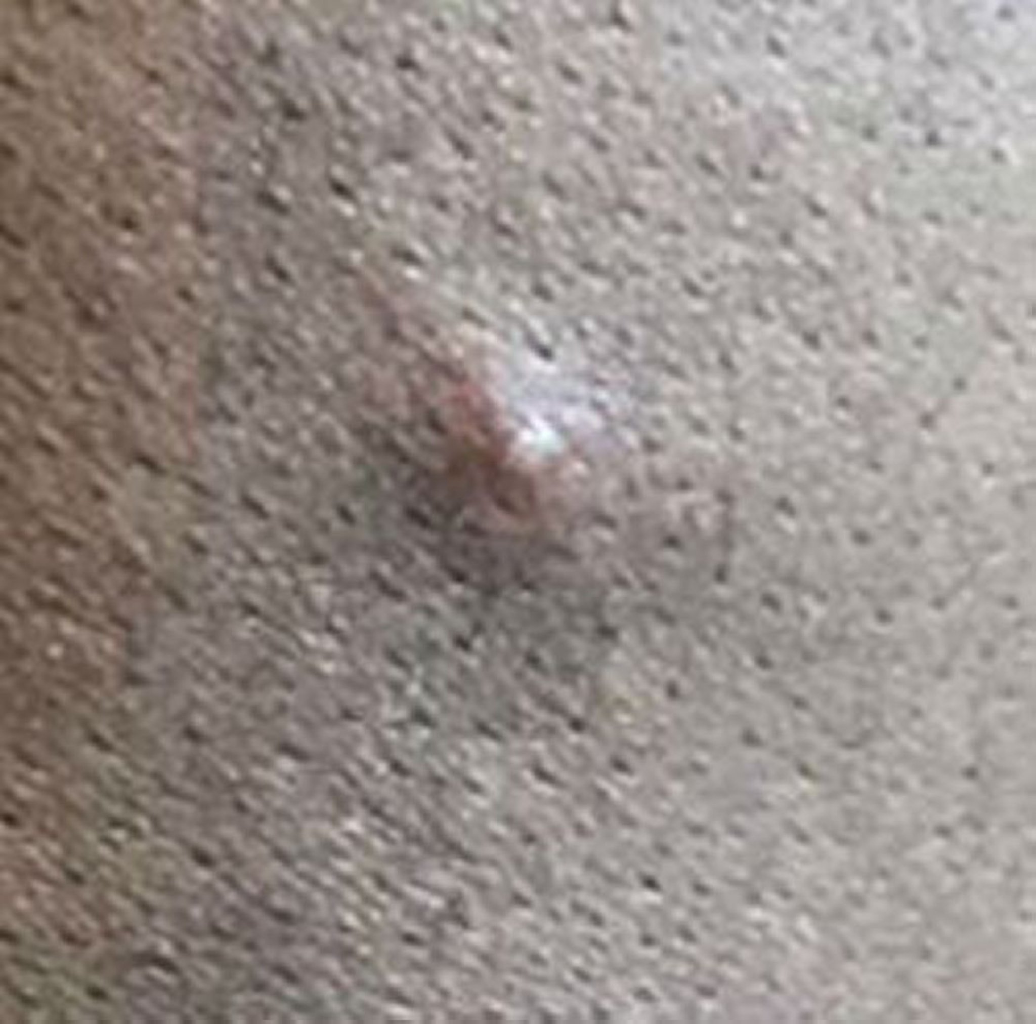 Mpox (3)