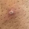 Mpox (4)