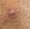 Mpox (4)