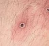 Mpox (5)