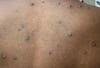 Mpox (6)