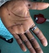 Mpox (7)