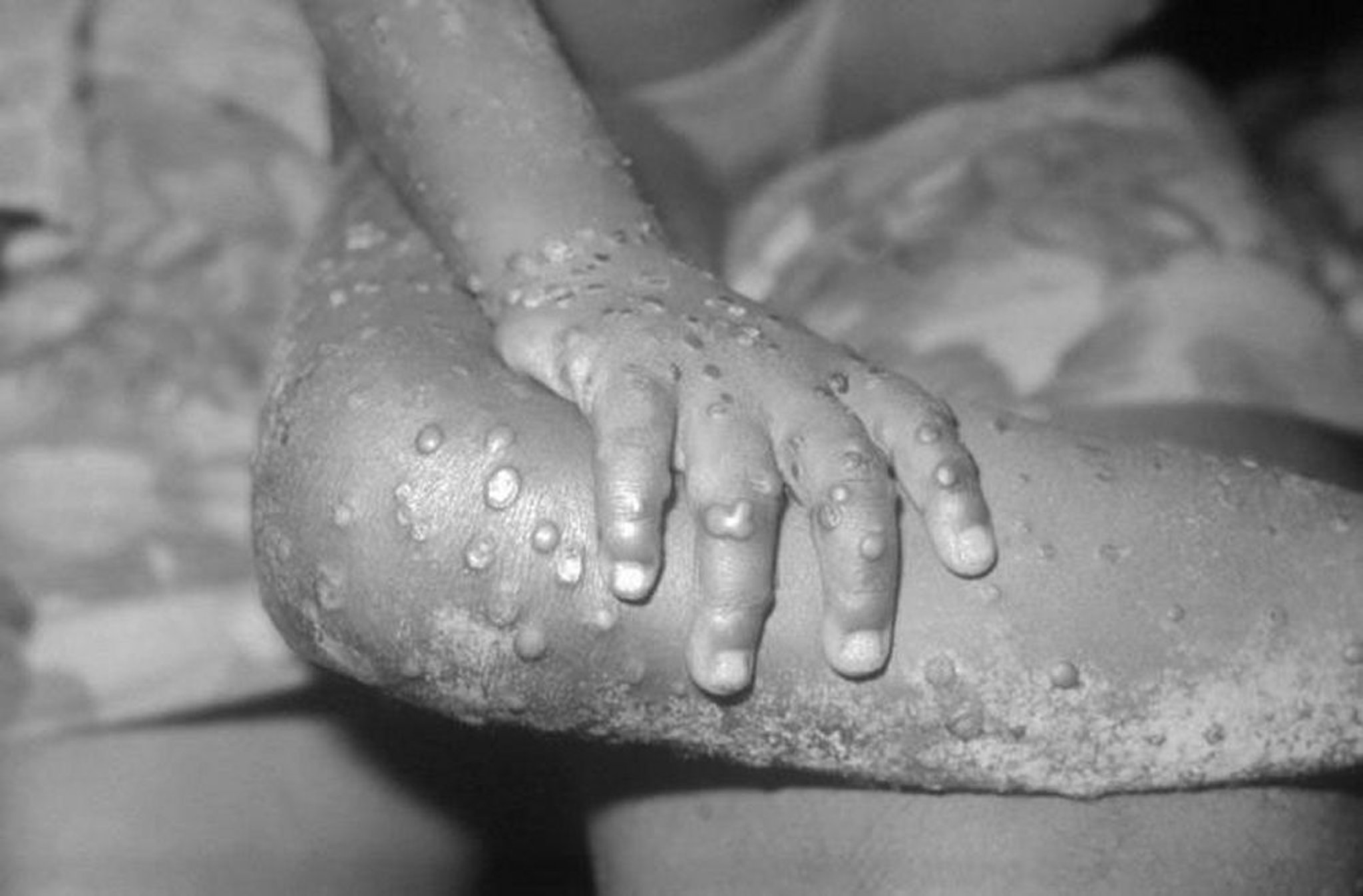 Mpox (1)
