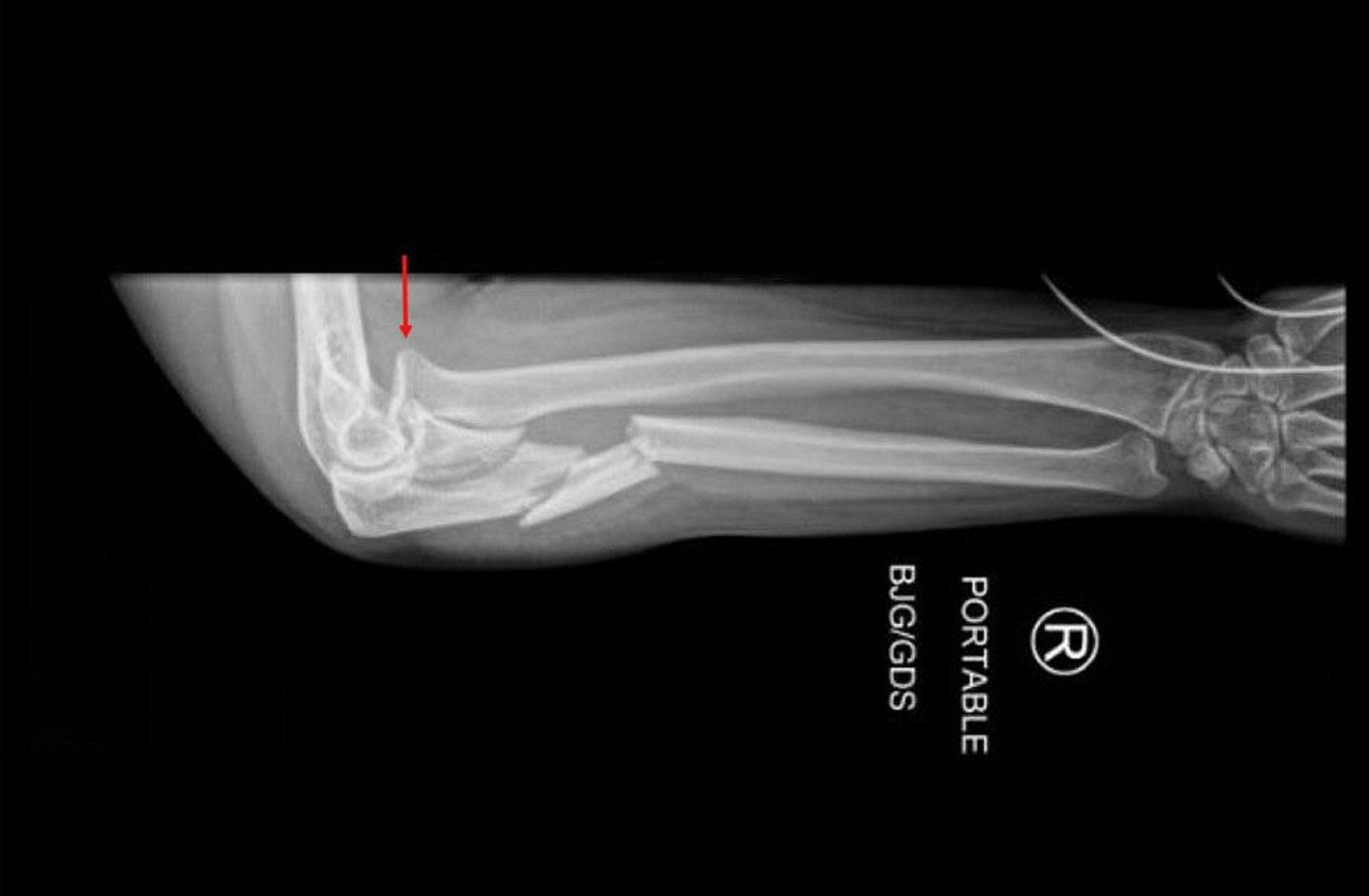 Monteggia Fracture Dislocation (2)