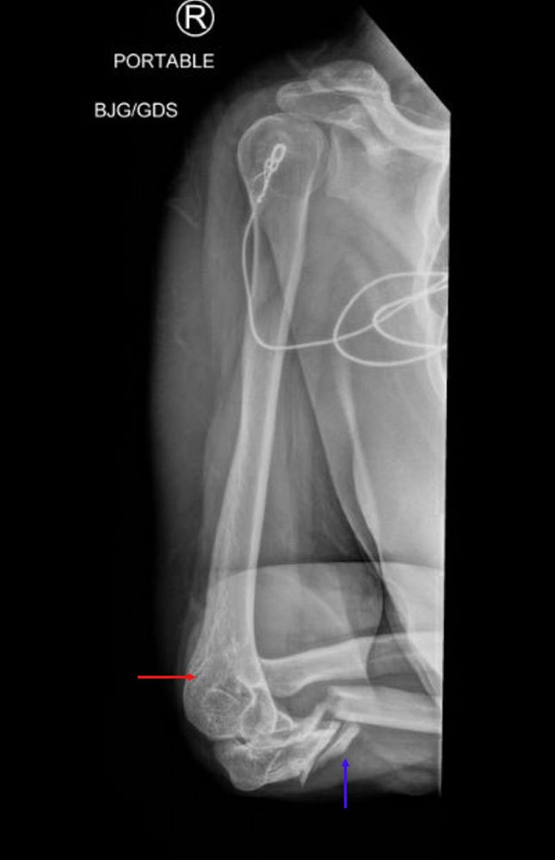 Fractura-luxación de Lisfranc (1)