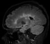 多発性硬化症のMRI（FLAIR）像
