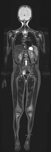 Resonancia magnética de la inversión de T1 corta (STIR MRI) del cuerpo entero