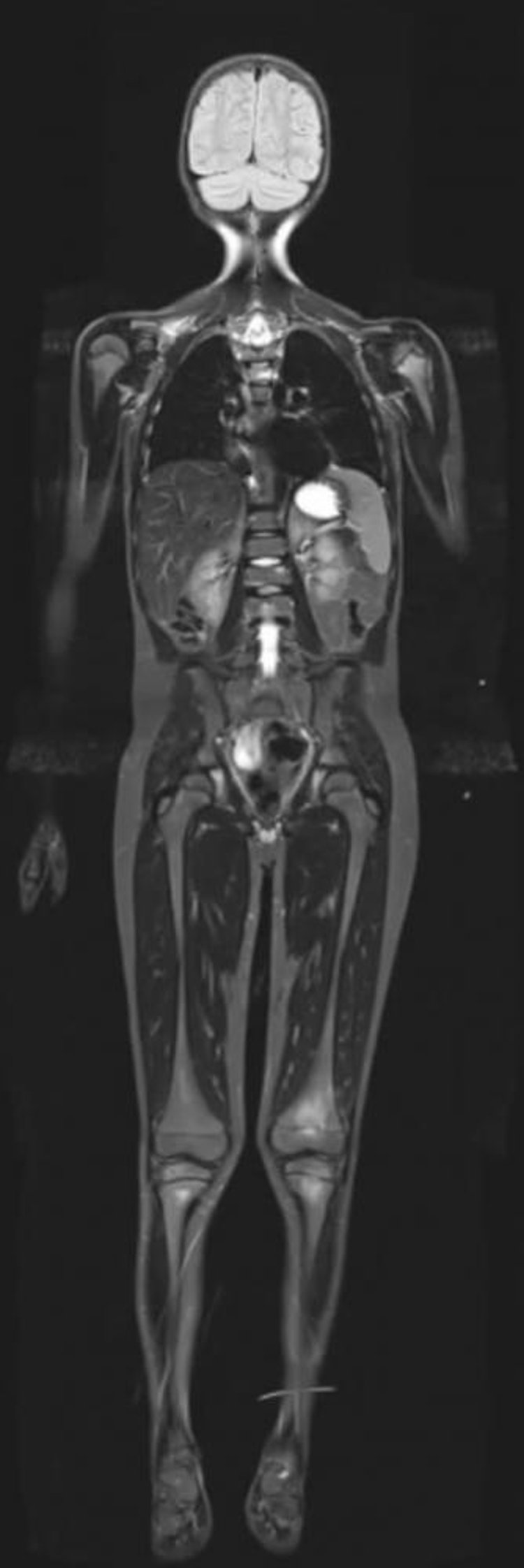 全身のshort, tight inversion recovery MRI