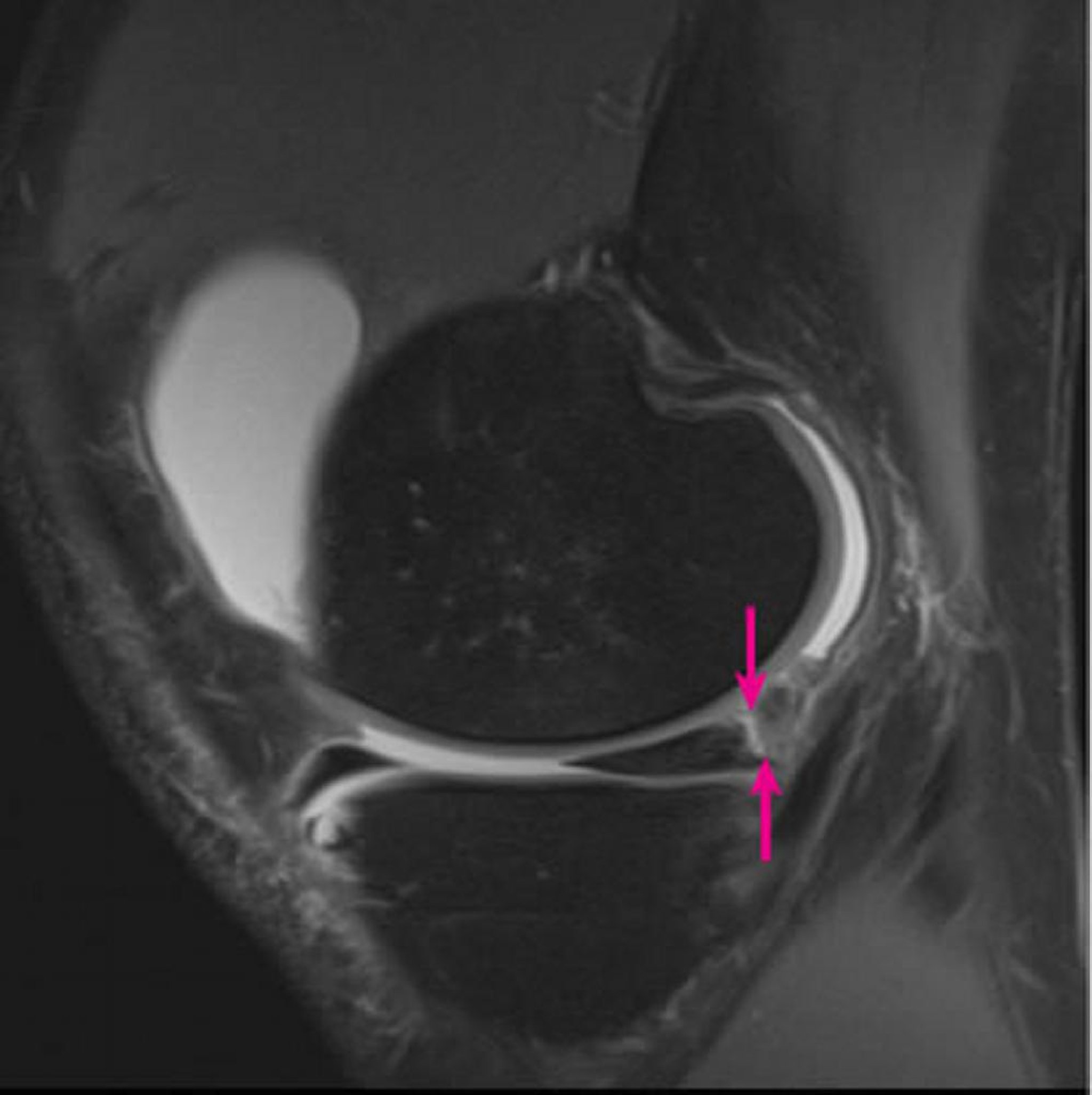 膝関節のMRI
