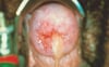 Mucopurulent Cervicitis