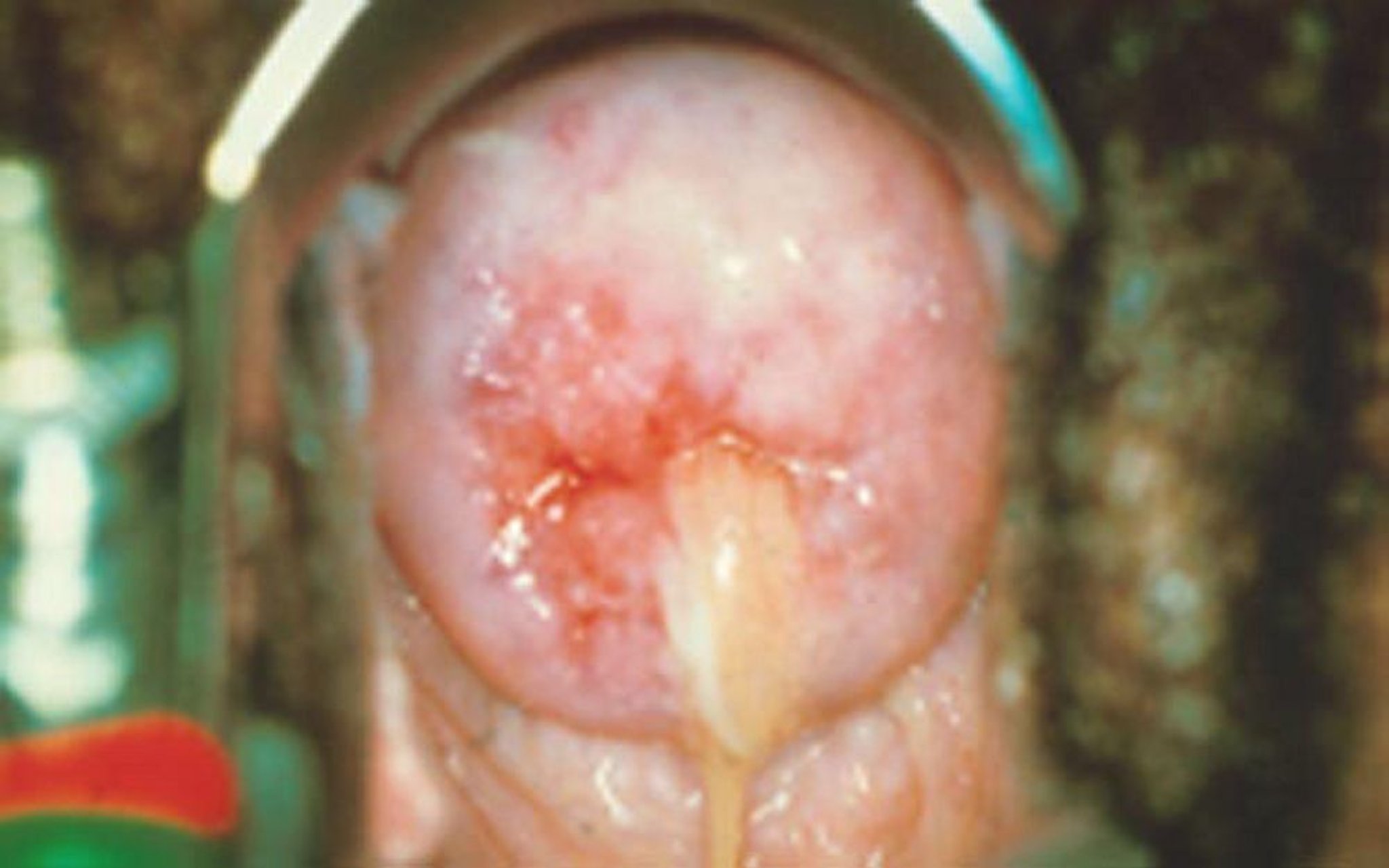 Cervicitis mucopurulenta