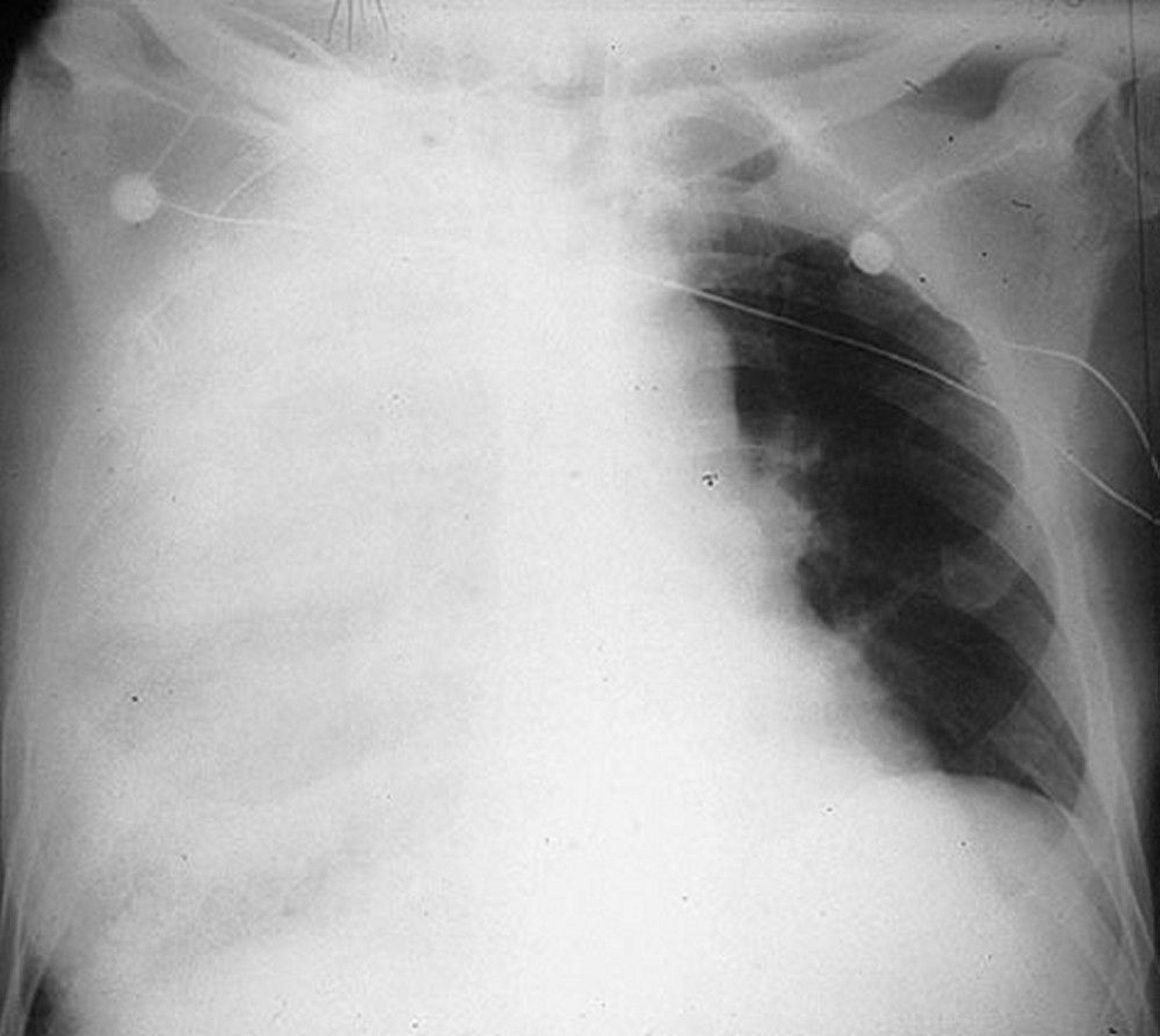 Multilobar Pneumonia