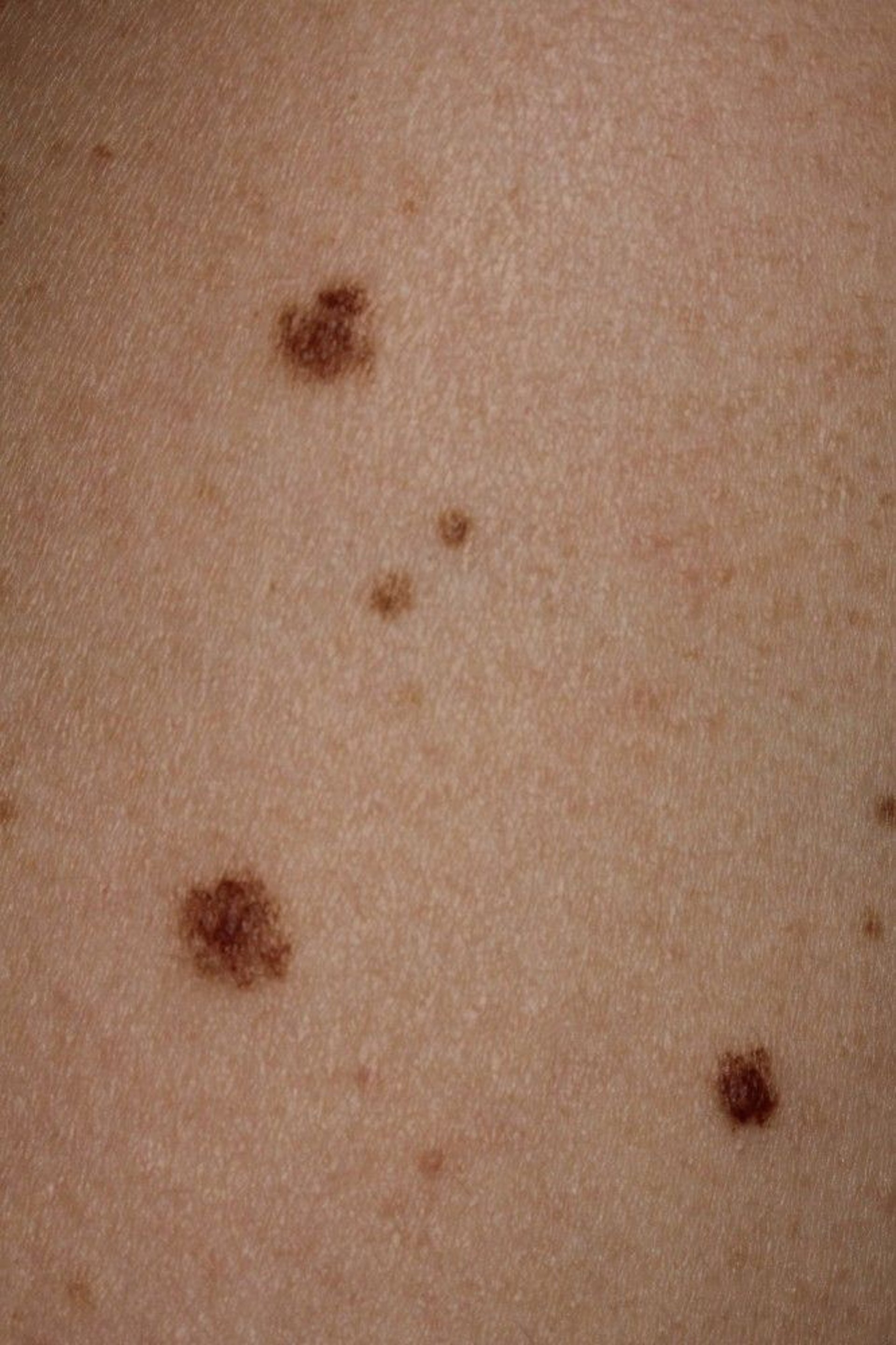 Multiple Atypical Nevi