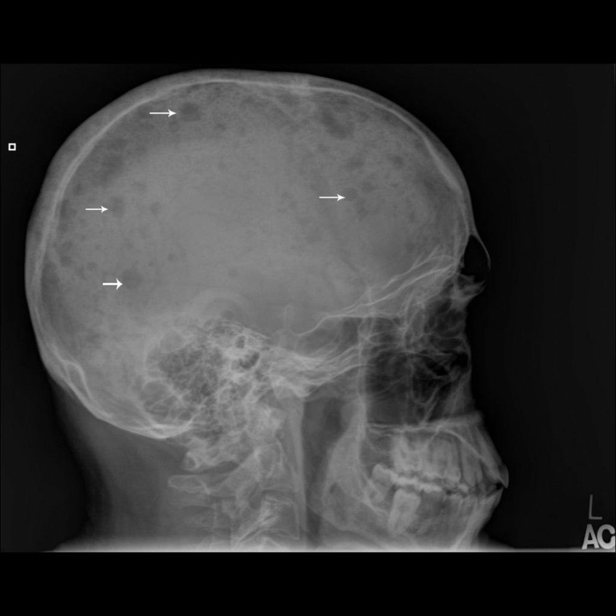 Multiples Myelom