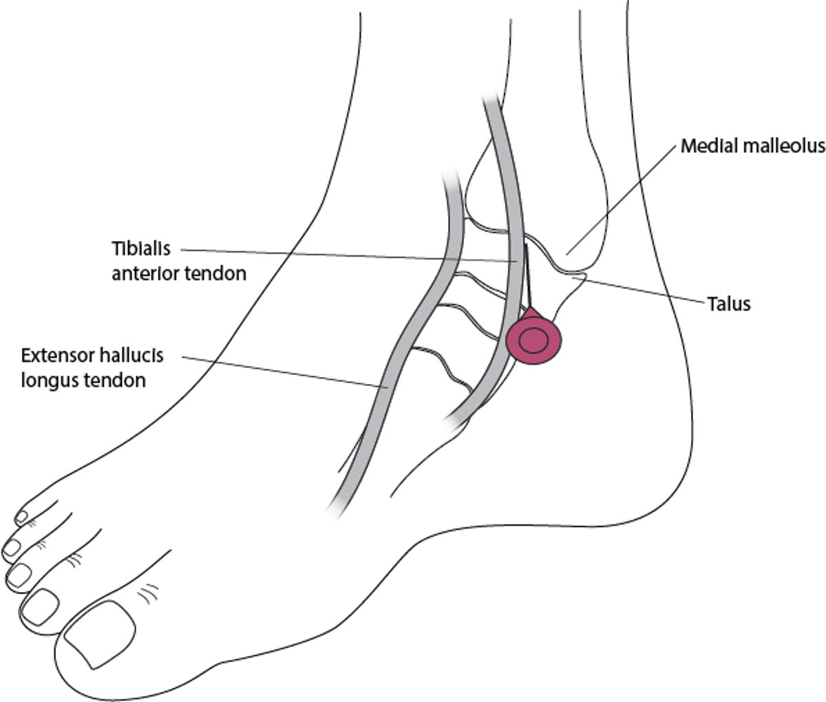 Arthrocentesis of the ankle