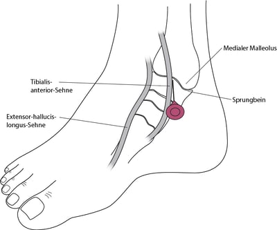 Arthrozentese des Knöchels