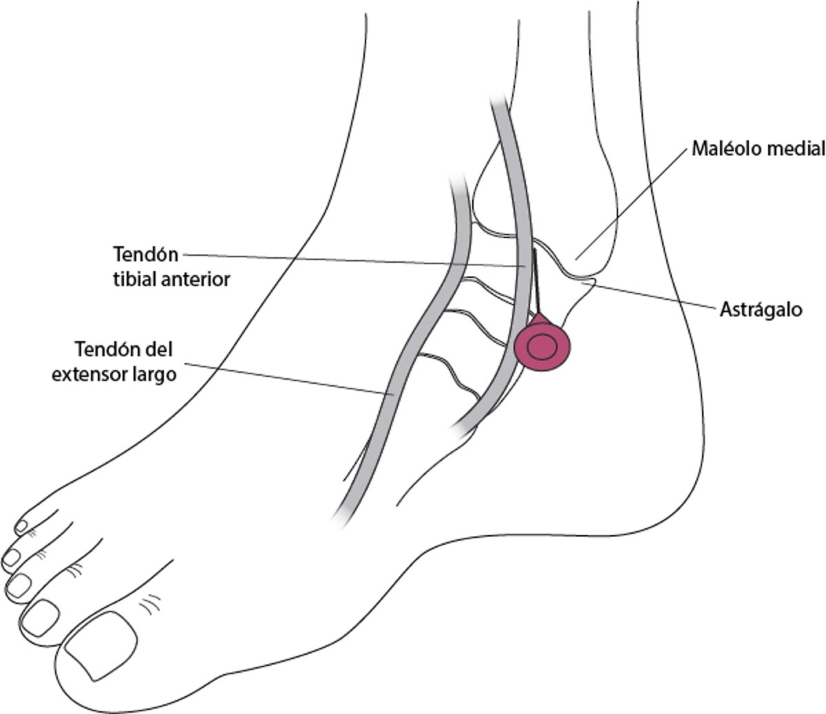 Artrocentesis del tobillo