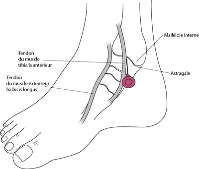 Arthrocentèse de la cheville