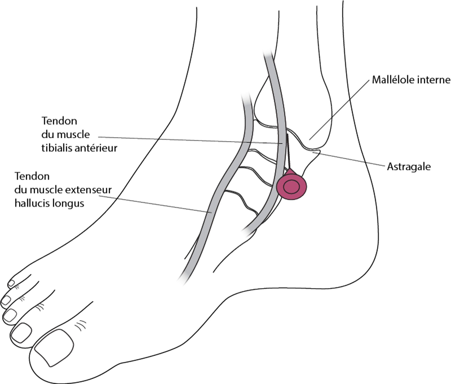 Arthrocentèse de la cheville