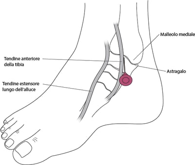 Artrocentesi della caviglia