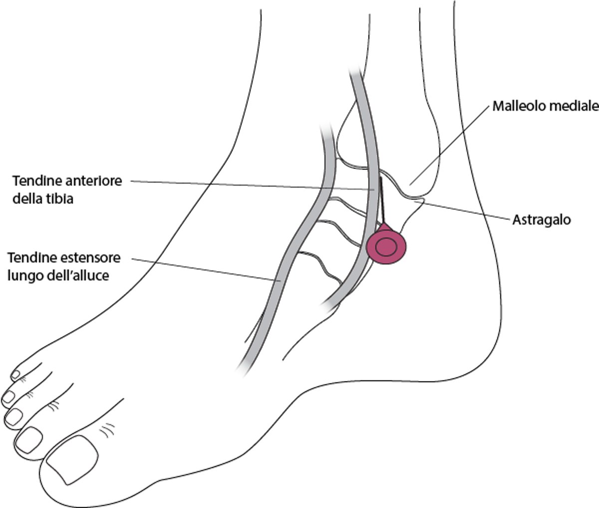Artrocentesi della caviglia