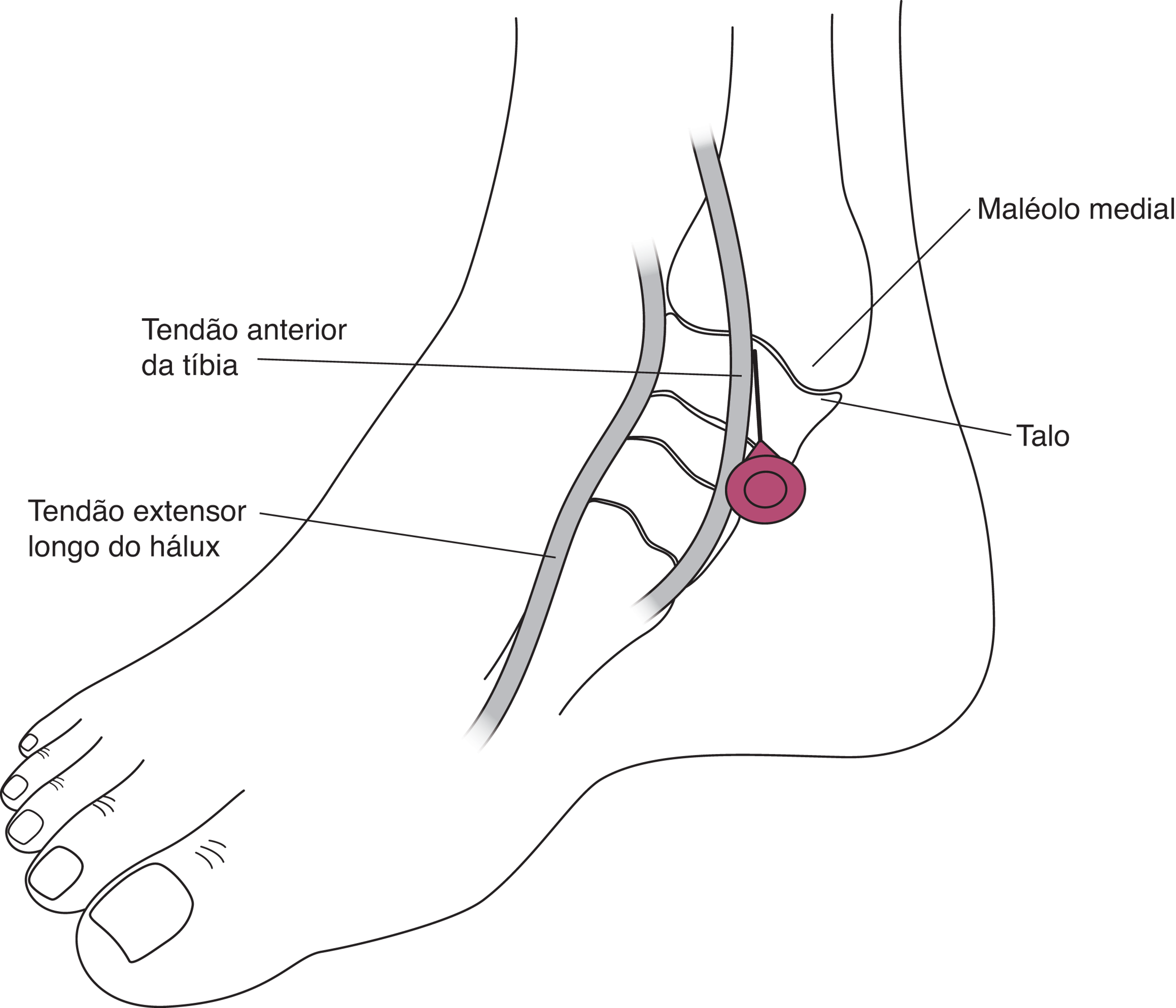 Artrocentese do tornozelo