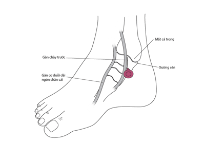 Chọc hút dịch khớp cổ chân.