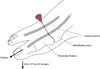 Arthrozentese der Metatarsophalangealgelenke