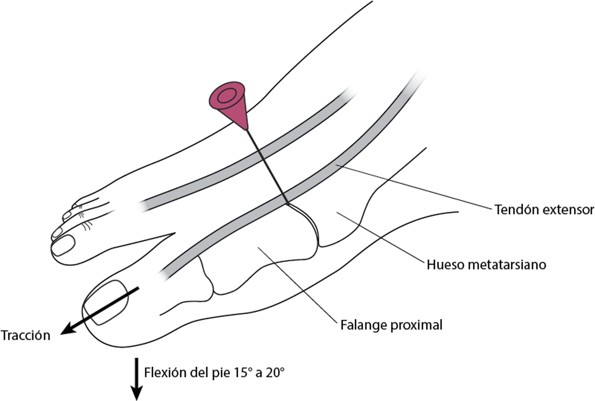 Artrocentesis de la articulación metatarsofalángica