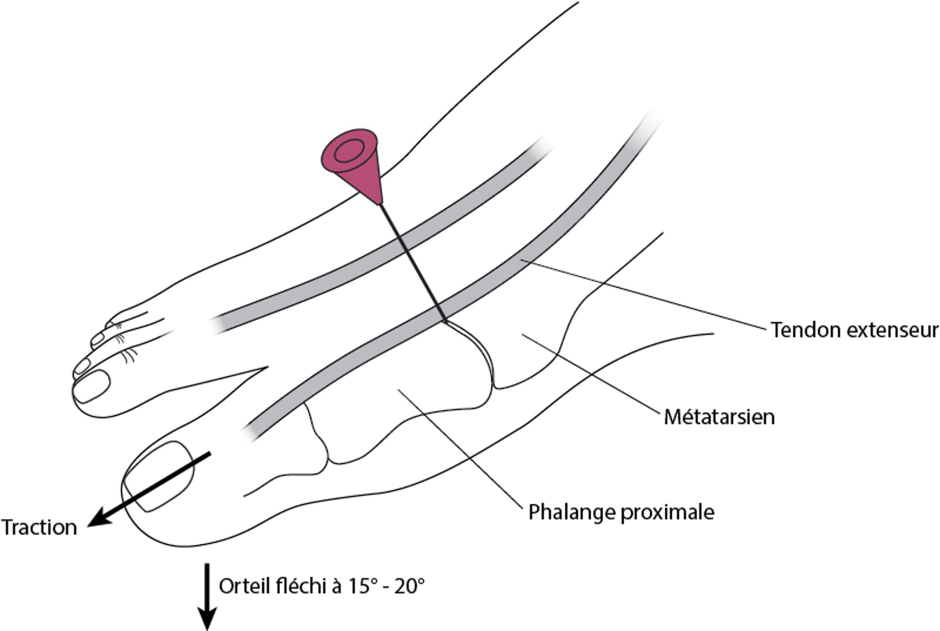 Arthrocentèse de l'articulation métatarso-phalangienne