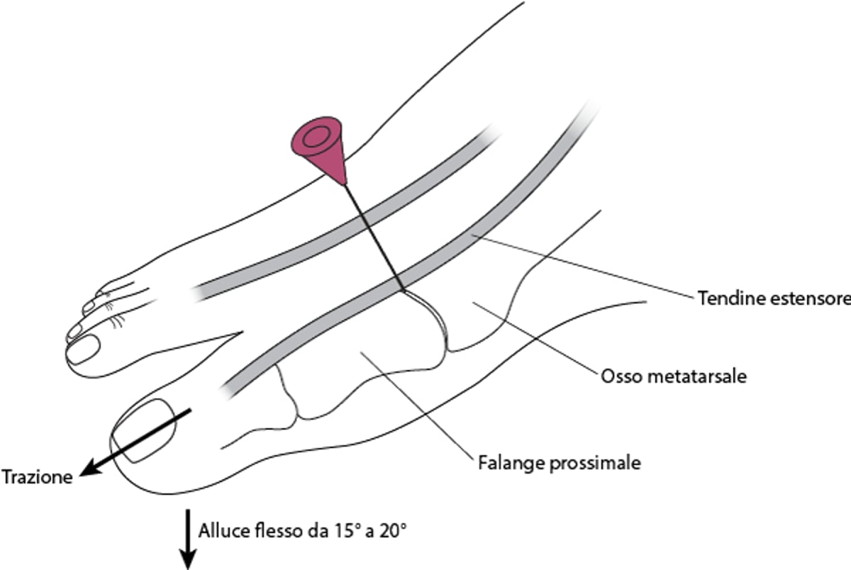Artrocentesi dell'articolazione metatarsofalangea