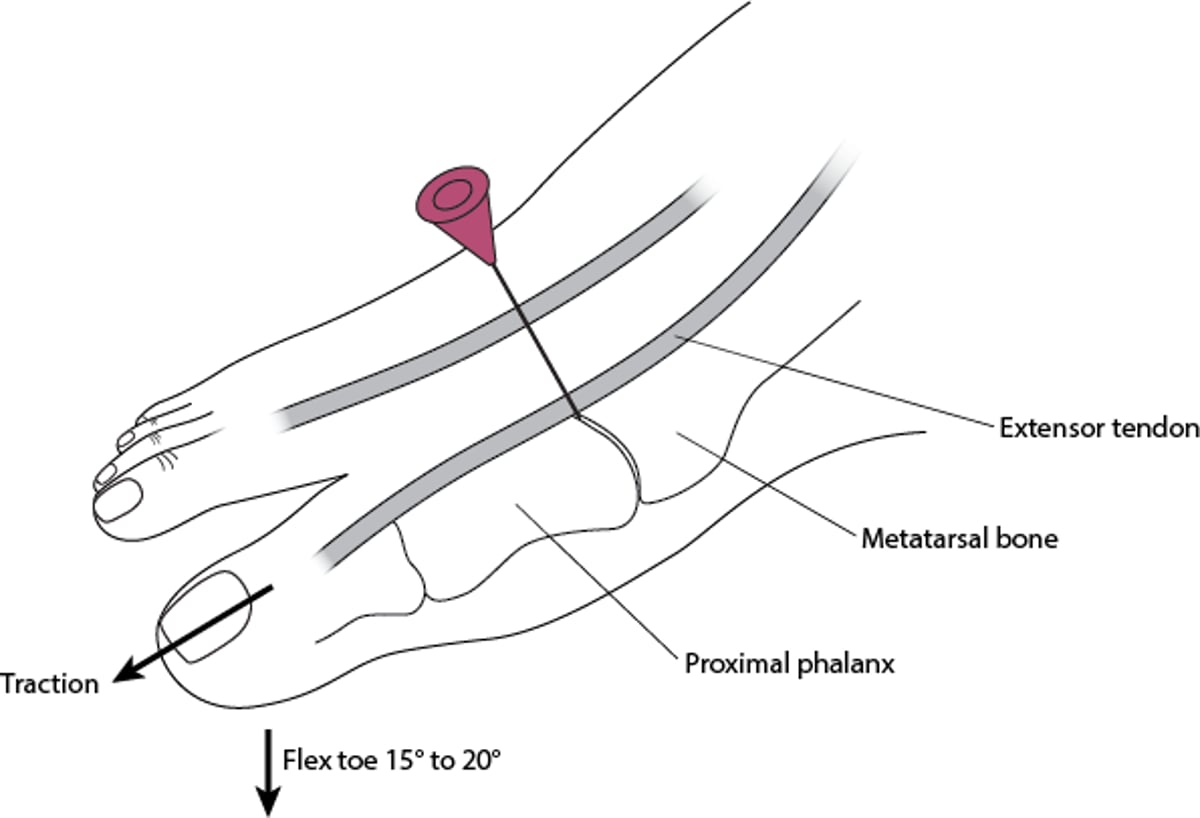 中足趾節関節の関節穿刺