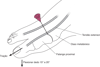 Artrocentese da articulação metatarsofalângica