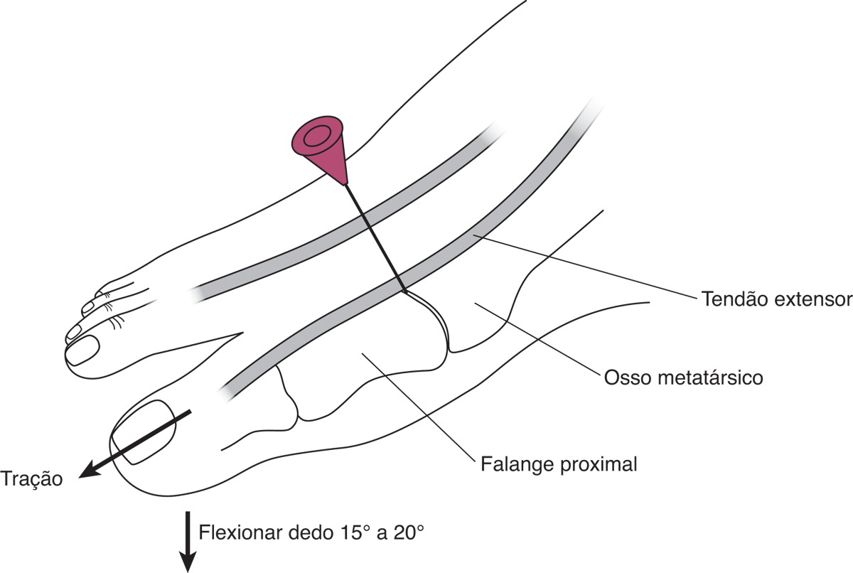 Artrocentese da articulação metatarsofalângica