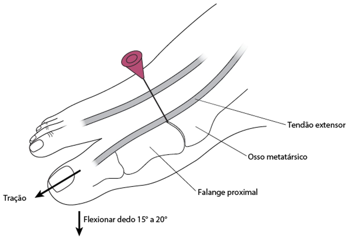 Artrocentese da articulação metatarsofalângica