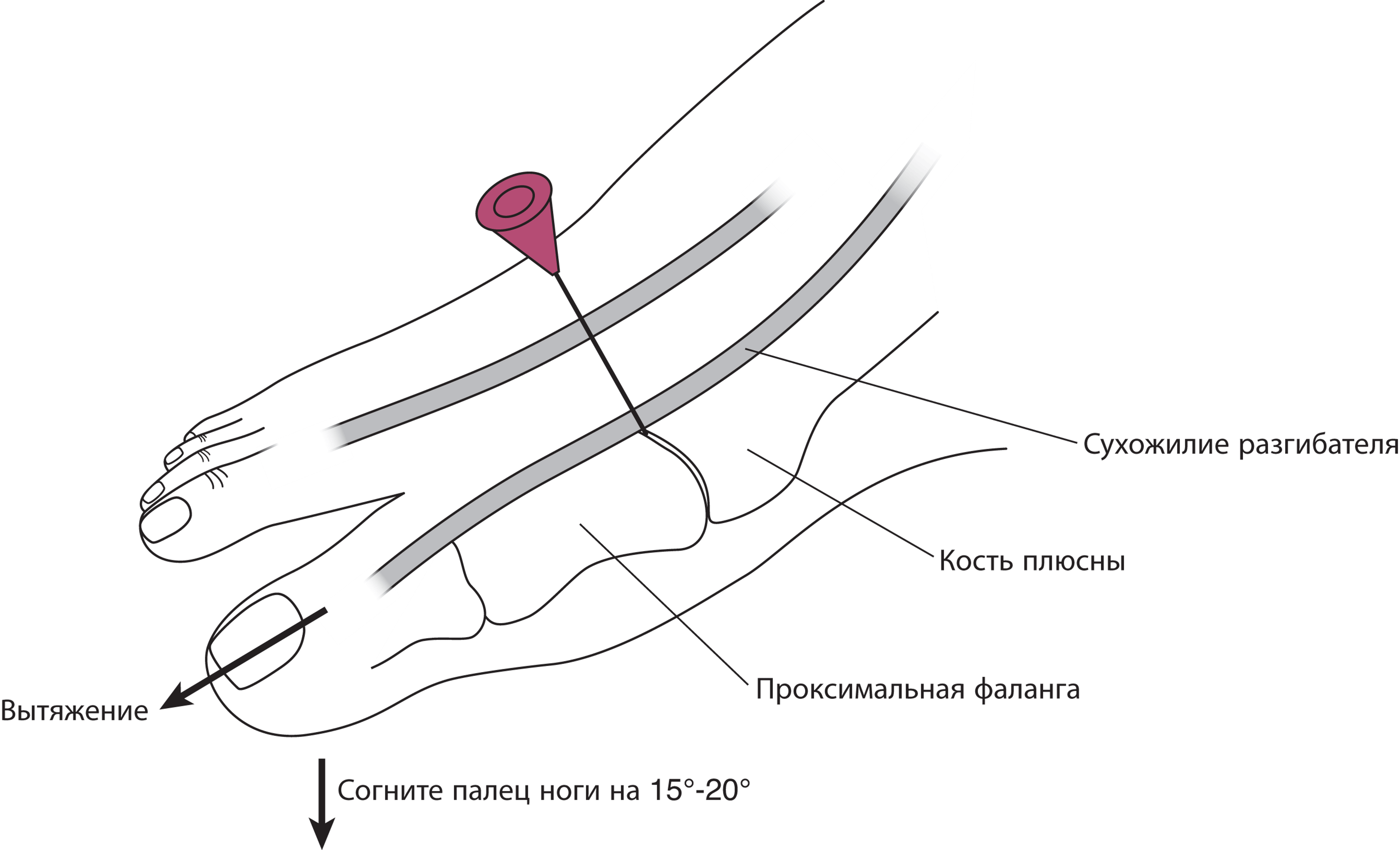 Пункция плюснефалангового сустава.