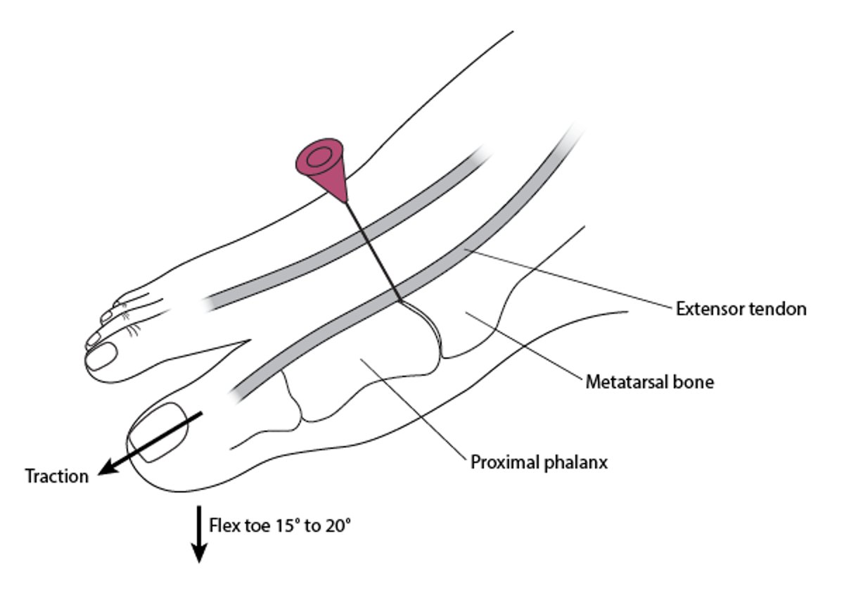 跖趾关节穿刺术