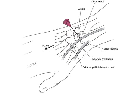 Arthrocentesis of the wrist